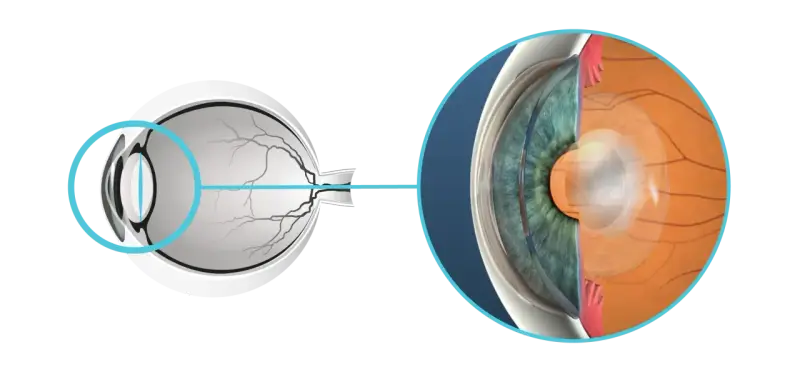 Sezione dell'occhio che mostra la lente e la retina. Si notano aloni dopo capsulotomia, un effetto visivo comune.